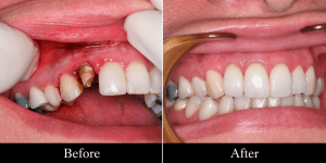 Before-and-after view of a fractured side tooth restored with a dental crown, matching the surrounding teeth