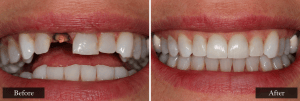 Before-and-after close-up of a patient with a missing front tooth fully restored with a natural-looking dental implant