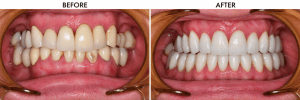 Before-and-after photo showing yellowed, uneven teeth transformed into a straight, bright white smile