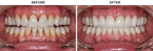Before-and-after comparison showing dull, discolored teeth brightened after professional teeth whitening
