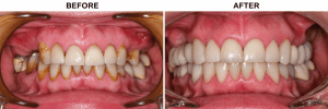 Before-and-after photo of teeth with heavy surface staining and plaque restored to a clean, healthy appearance