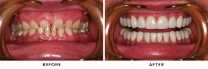 Before-and-after comparison of spaced and stained teeth corrected with cosmetic dental restorations