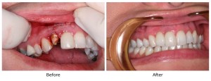 Before-and-after view of a severely broken upper front tooth fully restored with a natural-looking dental crown