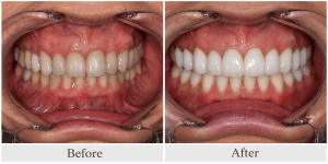 Before-and-after close-up comparison showing yellowed, stained teeth restored to a bright white, uniform smile