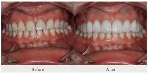 Before-and-after comparison of discolored, uneven teeth transformed into a bright and symmetrical smile with cosmetic veneers