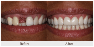 Before-and-after close-up showing a missing front tooth replaced to create a full, seamless smile